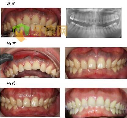 牙龈发炎