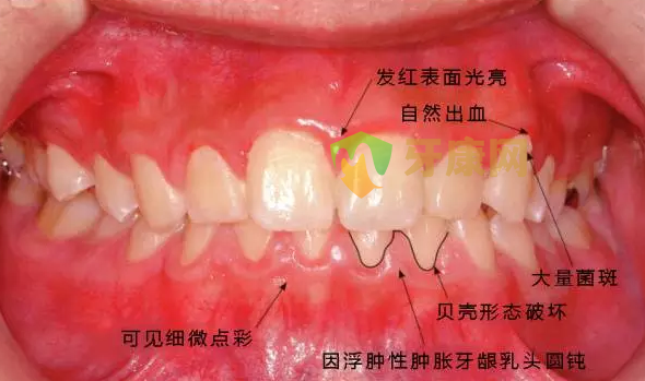 患牙龈炎的牙周组织