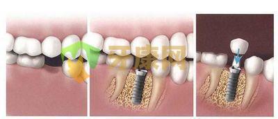种植牙植骨价格多少