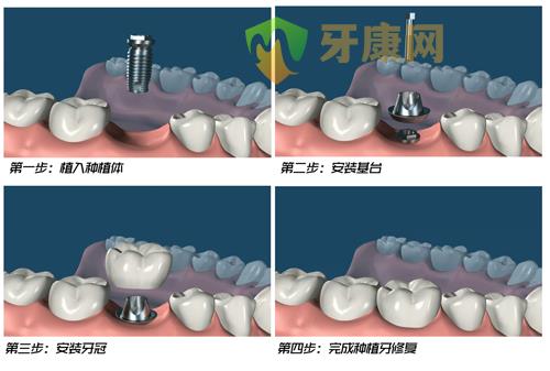 缺牙后何时种牙比较好？