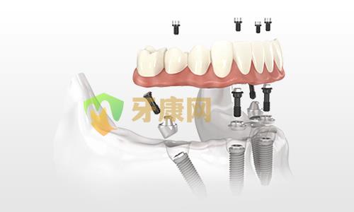 什么是即刻负重