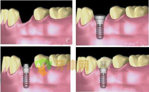 即刻种植牙的优缺点