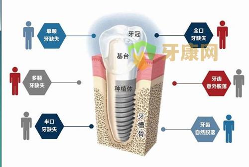 种植牙的注意事项