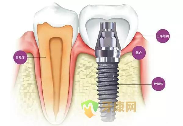 种植牙会蛀牙吗