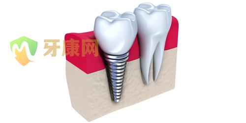 种植牙伤口多久愈合
