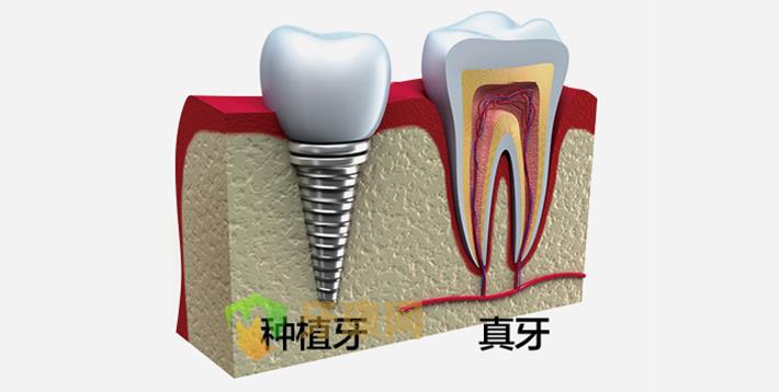人工种植牙价格