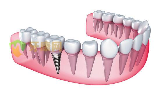一颗种植牙齿可以用久