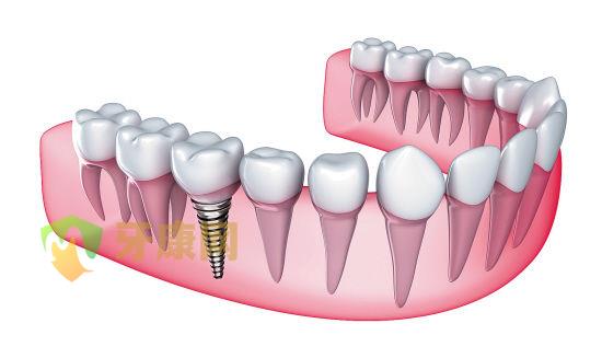 种植牙可以用多久