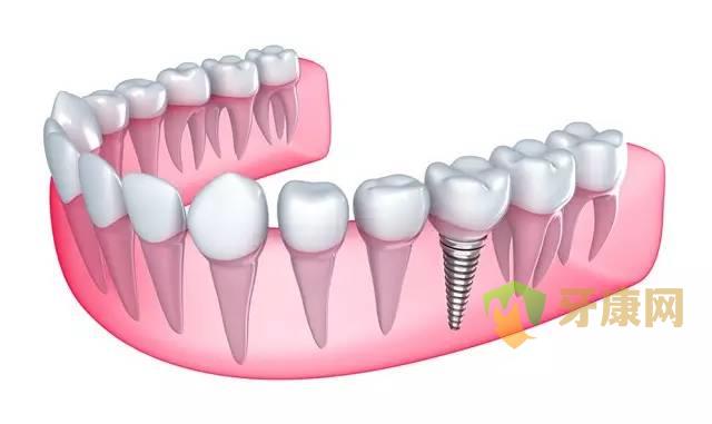 拨完牙后马上种植牙好吗