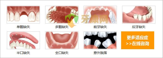 种植牙修复多颗牙齿缺失结果好吗