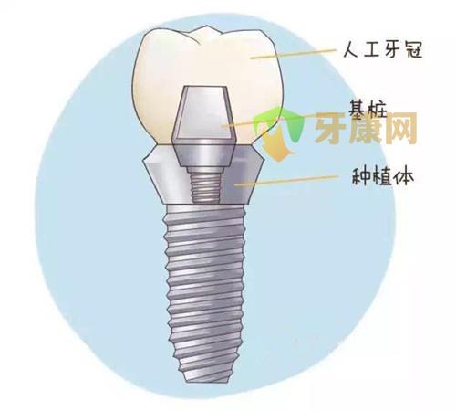 种植牙和美容冠的区别