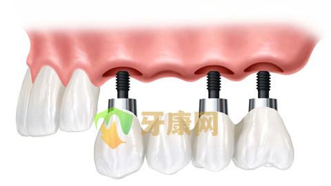 多颗牙种植的结果如何