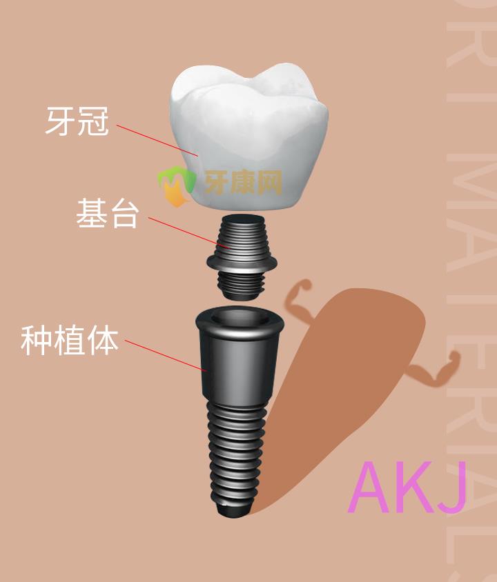 种植牙结构组成图