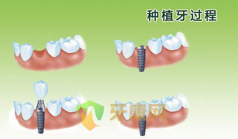 种植牙过程