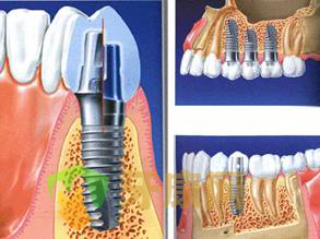 深圳牙健网种植义齿疼不疼？