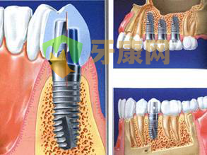 种植牙的价格越贵，结果就越好