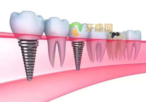 目前常见的种植牙材料有哪些？