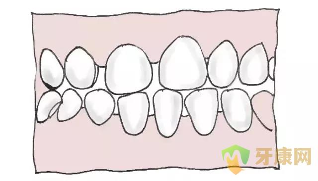 牙齿稀疏