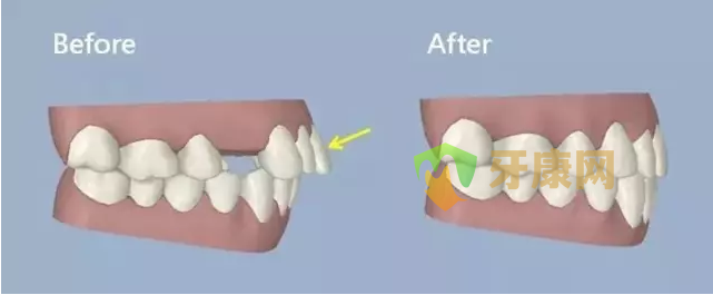 成年人牙齿前突怎么矫正