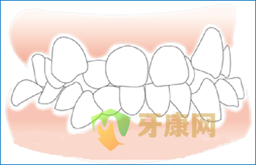 牙齿拥挤什么程度要拔牙？