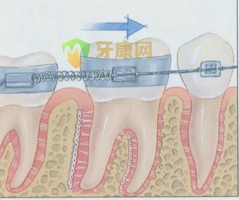 牙齿矫正的价格到底是谁说了算？