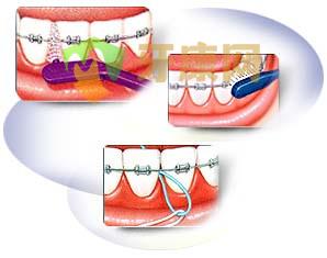  深圳正畸牙缝刷多少钱一支