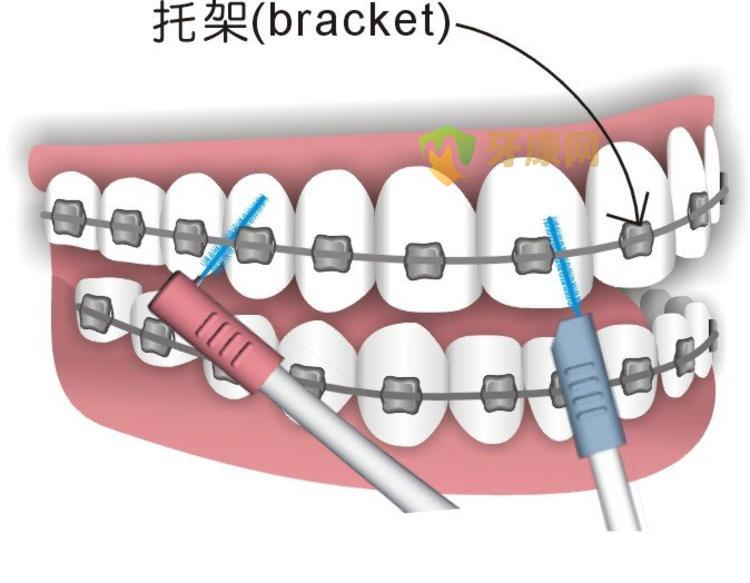 牙缝刷很鸡肋？牙缝刷到底有没有用？