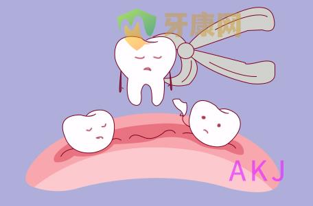 拔牙示意图片