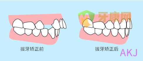 龅牙矫正