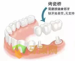 镶牙的方式