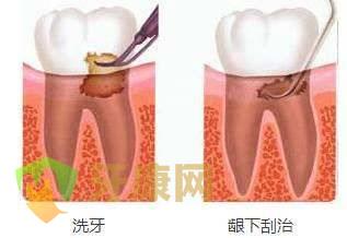 龈下刮治的作用