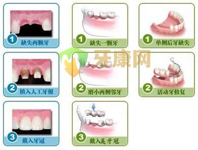 镶牙有用吗？ 会不会有什么副作用？