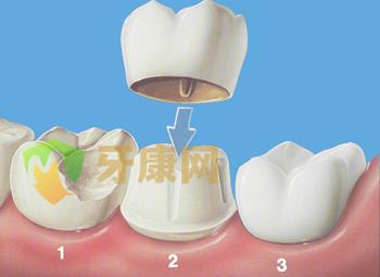 贵金属美容冠结果好吗？