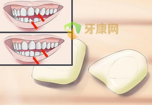 牙齿贴面材料有哪些？