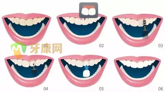 牙齿贴面和烤瓷牙，哪一个结果更好？