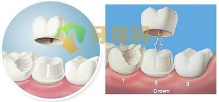 美齿冠和瓷贴片哪个好