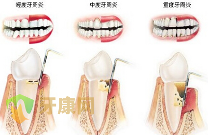 牙周炎怎么治疗？