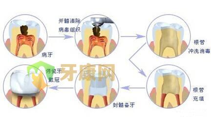 杀牙神经后牙齿还能撑多久？