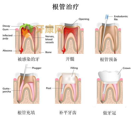 什么是根管治疗