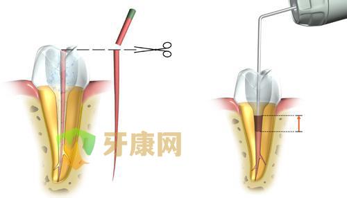 根管治疗的作用