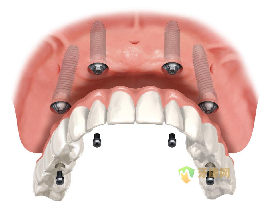 全口种植牙多少钱