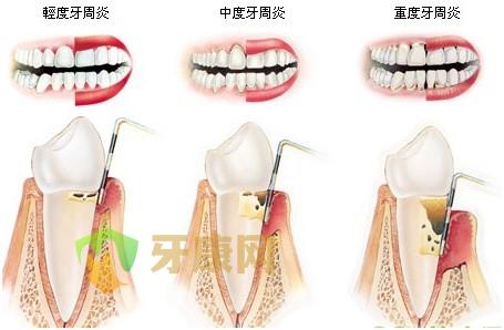 牙周炎的症状