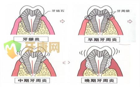 治疗牙周炎的价格