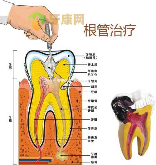 根管治疗痛吗