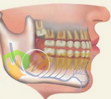 智齿怎么办