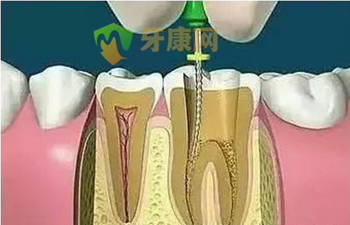 什么是抽牙神经