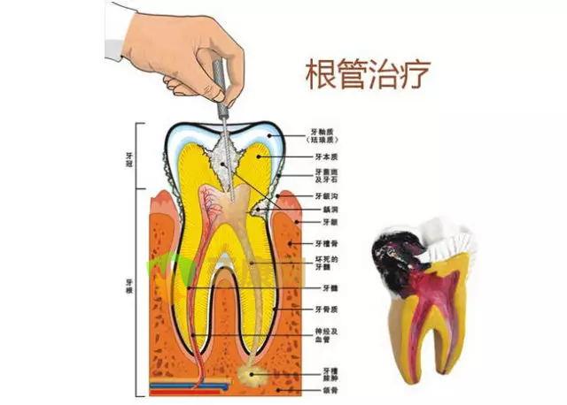 根管治疗的作用