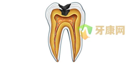 根尖周炎的原因