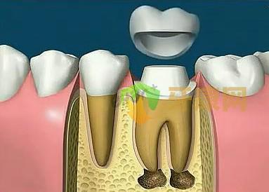 根管治疗后必须戴牙冠吗