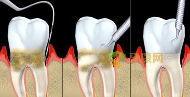 得了牙周炎怎么办